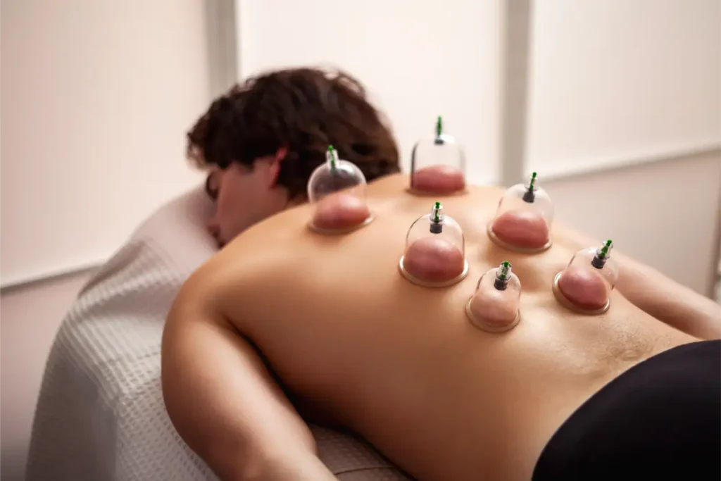 Hijama / Cupping Therapy